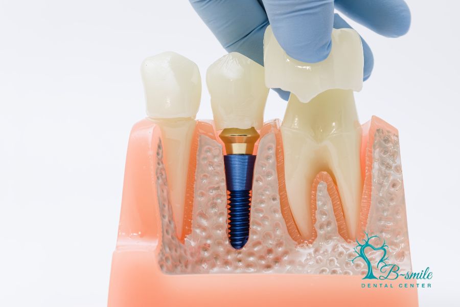 Zašto su zubni implantati već godinama jedno od najtraženijih rješenja u dentalnoj medicini?
