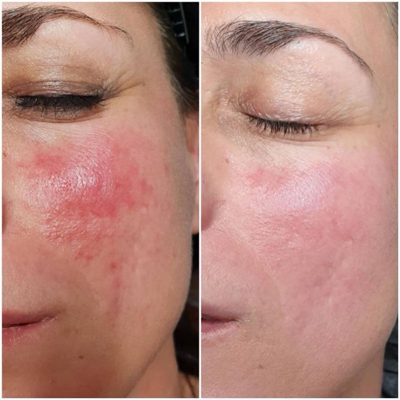 ROZACEA UKLANJANJE CRVENILA