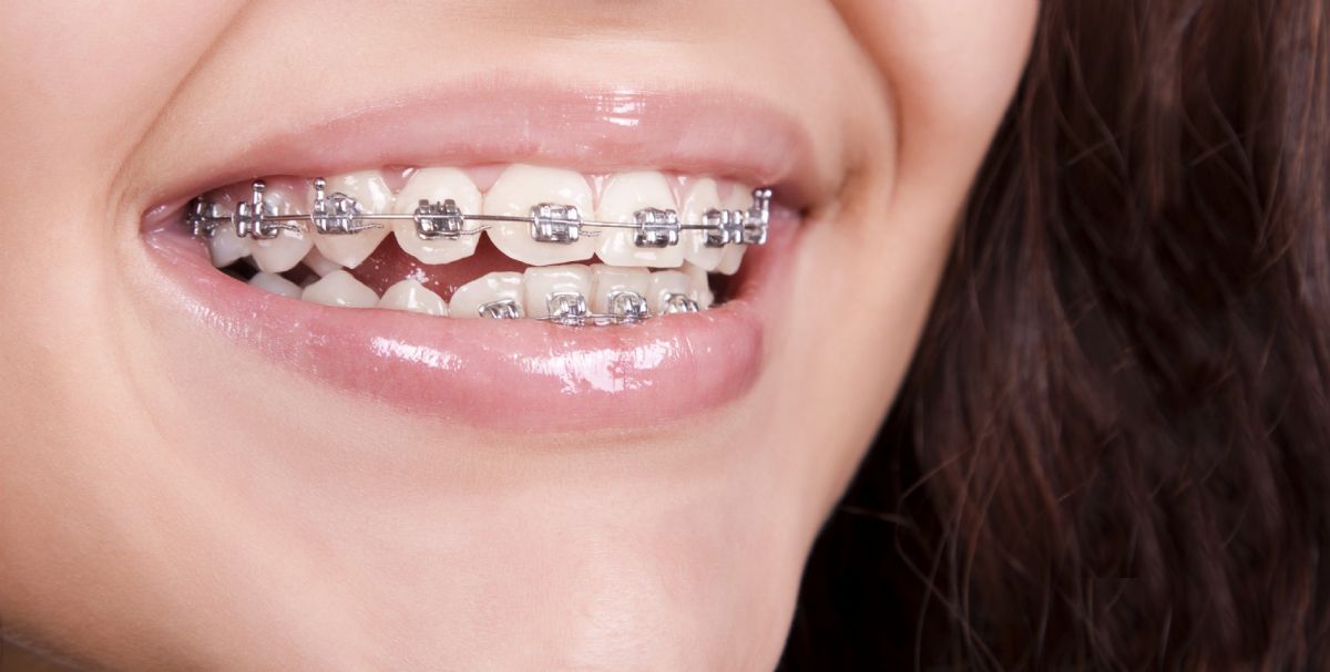 Kada je idealno vrijeme za posjet ortodontu? (video)