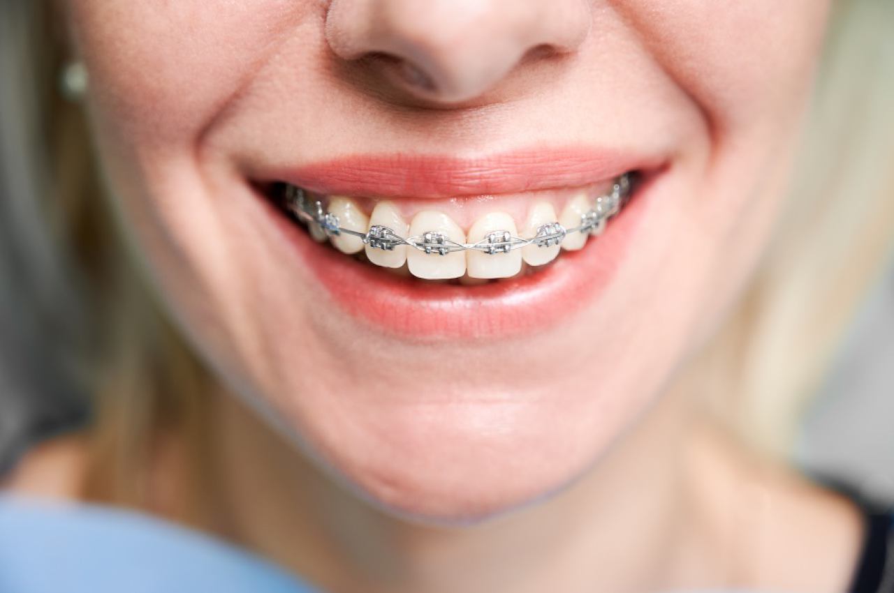Ortodoncija za djecu i odrasle Poreč