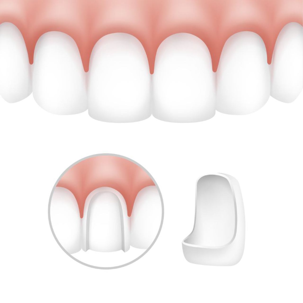 Dentalni implantati, ljuskice za zube