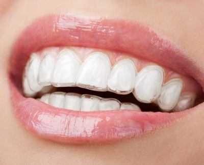 Nevidljive sekvencijalne udlage za ispravljanje zubi