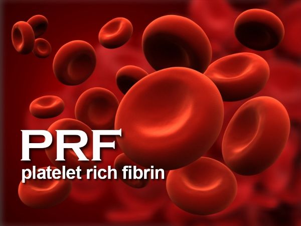 Platelet Rich Fibrin (PRF)