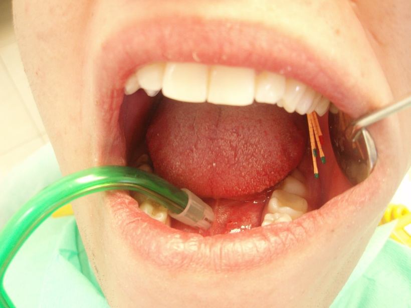ENDODONCIJA - LIJEČENJE KORIJENSKIH KANALA ZUBA
