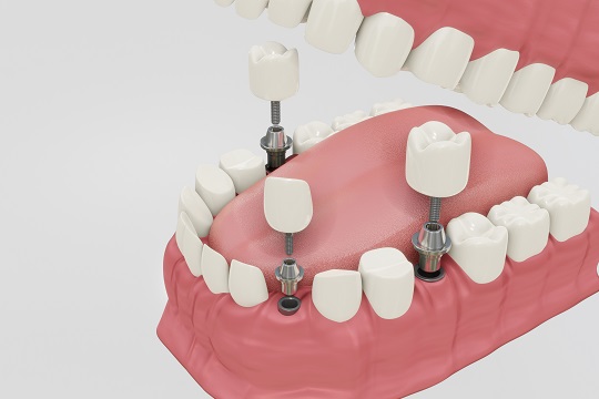 dentalni implantati