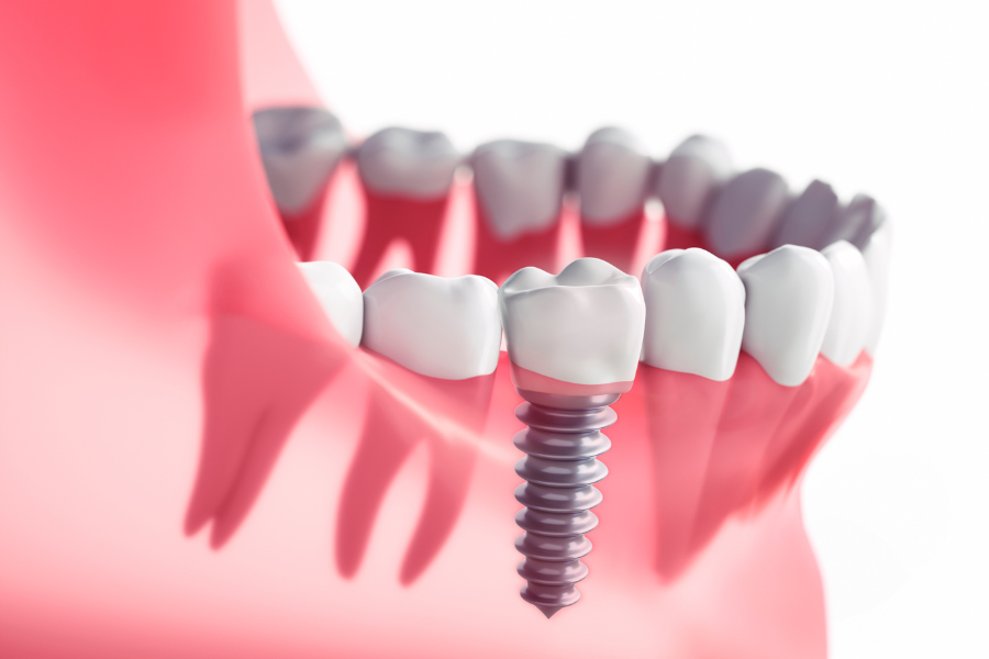 dentalni implantati